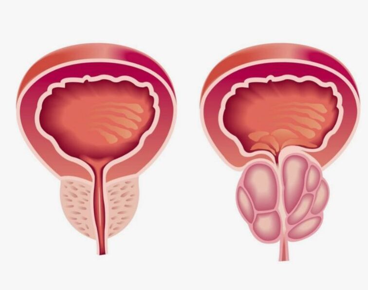 vesela un slima prostata
